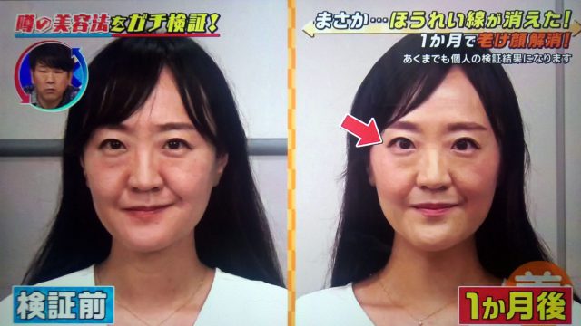 【この差って何ですか？】ほうれい線を消す美容法で老け顔が解消できるかガチ検証