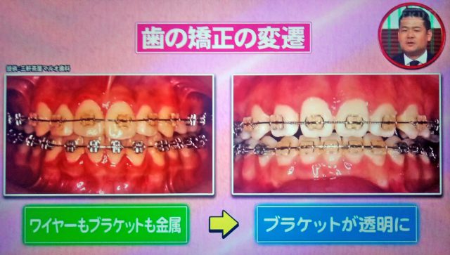 【ホンマでっかTV】令和の最新美容整形SP｜薄毛治療・歯列矯正・プチ整形の新常識ベスト10