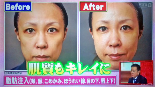 【ホンマでっかTV】令和の最新美容整形SP｜薄毛治療・歯列矯正・プチ整形の新常識ベスト10