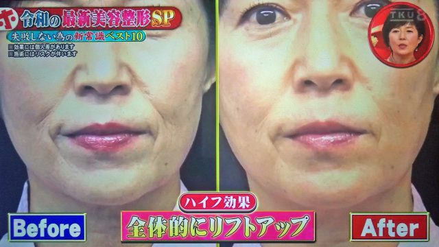 【ホンマでっかTV】令和の最新美容整形SP｜薄毛治療・歯列矯正・プチ整形の新常識ベスト10